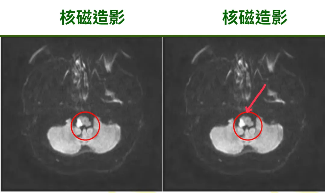 核磁共振影像顯示,患者腦幹右側(白色反光處)血管阻塞。(圖/臺中醫院)