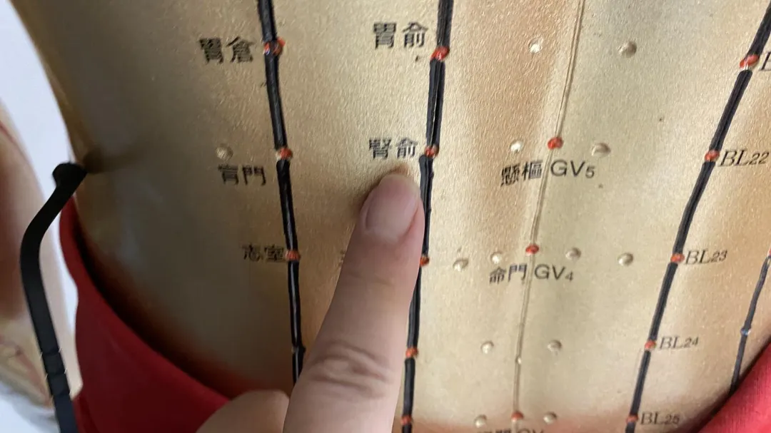 員榮醫院中醫部與腎臟科合作減緩慢性腎臟病患者腎臟惡化，中醫會針炙腎俞、百會及足三里等穴位。（圖／員榮醫院）