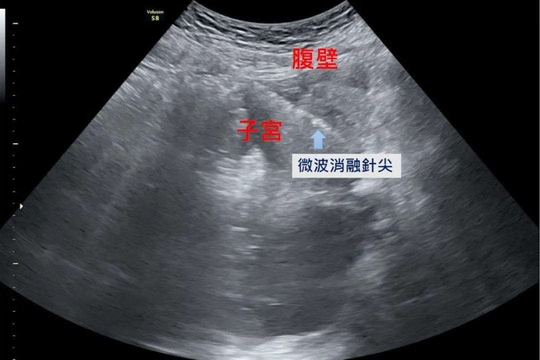 在腹腔鏡及婦科超音波的導引下，將消融針精準進入病灶，釋放高能量微波破壞異常內膜腺體組織，使其失去活性而逐漸縮小。（圖／台北慈濟醫院）