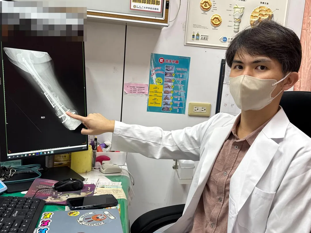 大甲李綜合醫院骨科醫師廖唯任使用髓內鋼釘為患者固定大腿。（圖／大甲李綜合醫院）