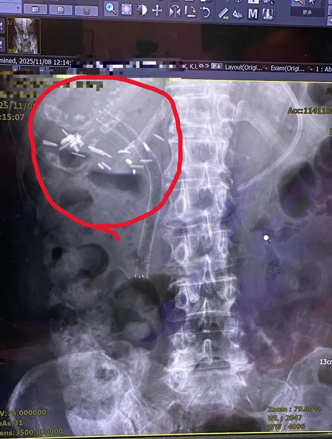 罹癌患者因膽管塞住,經員榮醫院胃腸肝膽科曾宇辰醫師放置金屬支架(圖中紅圈處)。(圖/員榮醫院)