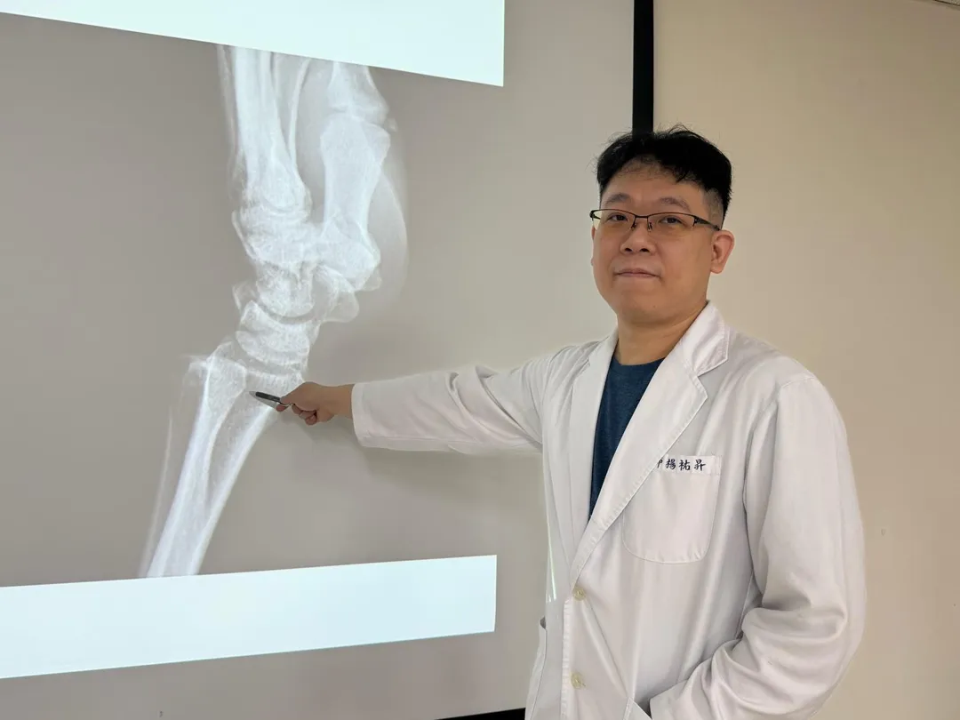 臺中醫院骨科楊祐昇醫師指著患者道院時X光片，說明患者右手尺骨與橈骨脫位位置。（圖／臺中醫院）