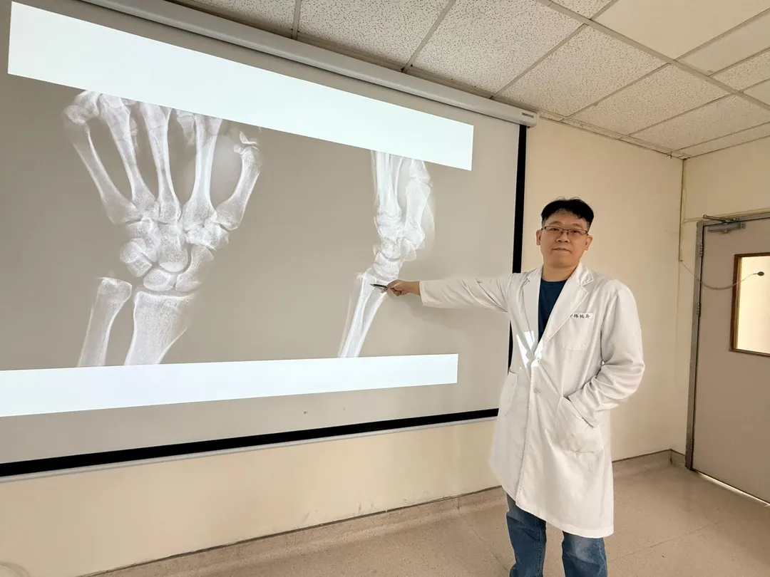 臺中醫院骨科楊祐昇醫師指著患者道院時X光片，說明患者右手尺骨與橈骨脫位位置。（圖／臺中醫院）