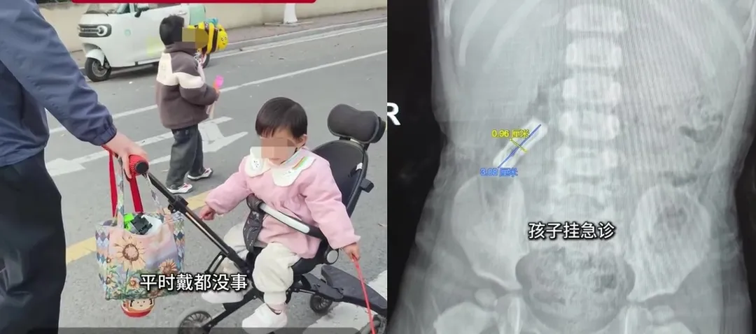 大陸安徽一歲多女童誤食髮夾。（圖／翻攝《篝火視頻》）