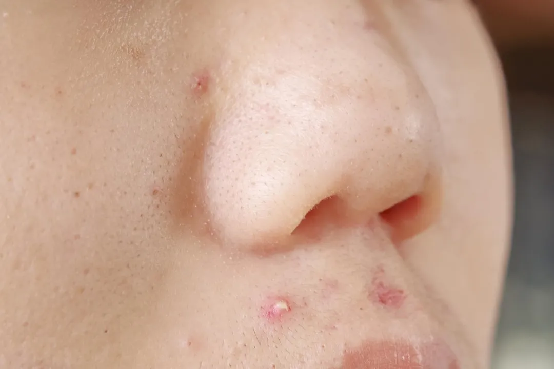 一名高中男生擅自購買藥物治青春痘，乳房卻出現異常發育。（示意圖，非當事人／photoAC）