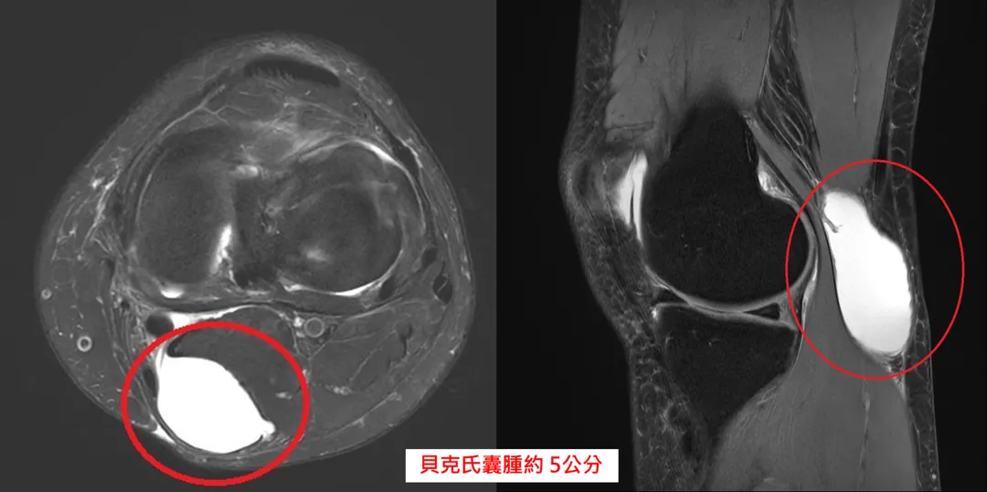 一名50歲女性患者摸到右腳膝窩有顆腫塊,上下樓梯、蹲跪時出現壓迫感,經診斷為貝克氏囊腫。(圖/中國醫藥大學新竹附設醫院)