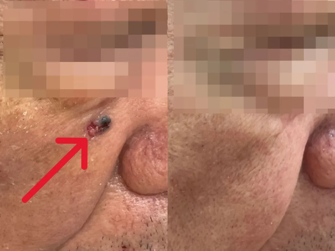 陳先生右臉出現黑色斑塊（左），切片檢驗確診為基底細胞癌，隨即接受皮膚腫瘤廣泛性切除手術，術後恢復良好（右）。（圖／台北慈濟醫院）