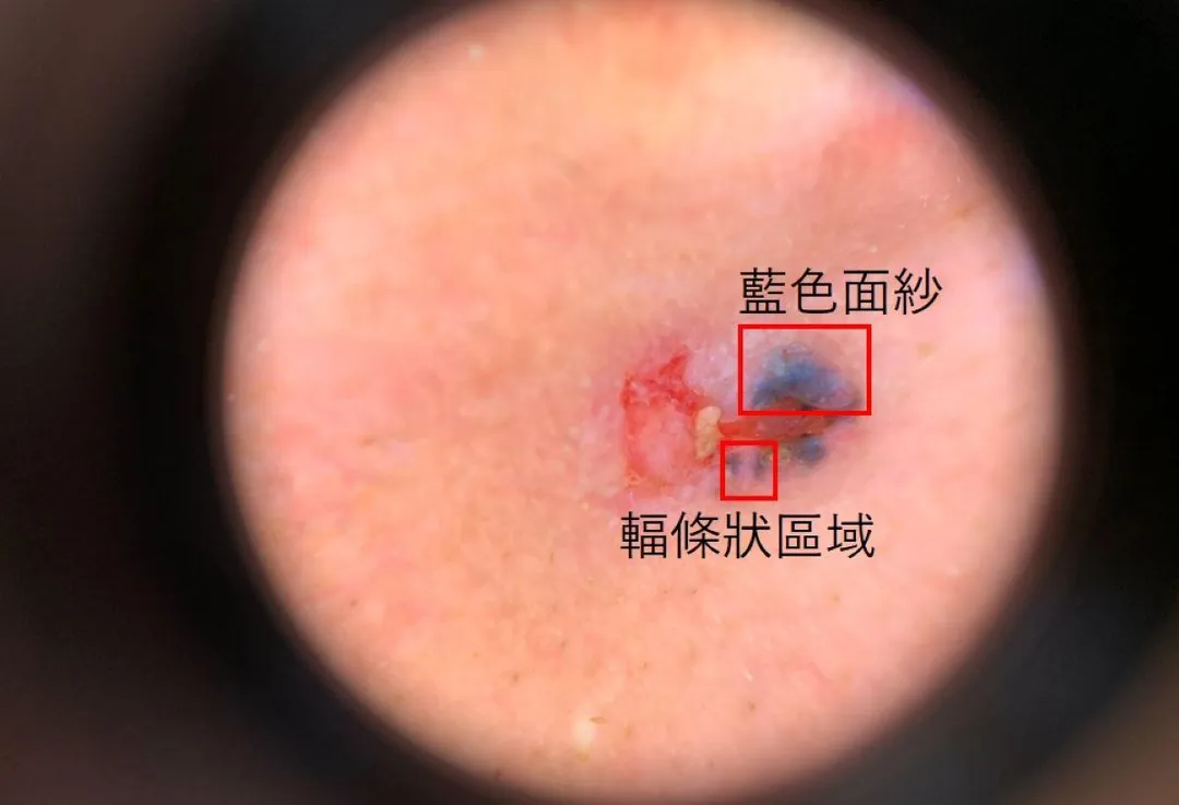 皮膚鏡檢查畫面下的病灶，可見輻條狀區域、藍白面紗、腫瘤潰瘍等基底細胞癌典型特徵。（圖／台北慈濟醫院）