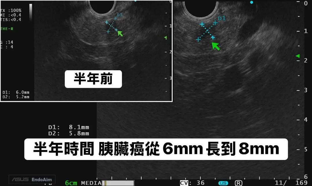 患者半年後才願意接受檢查,此時腫瘤已從0.6公分長大至0.8公分。(圖/林相宏臉書「胰臟醫師 林相宏 禾馨民權內科診所」)