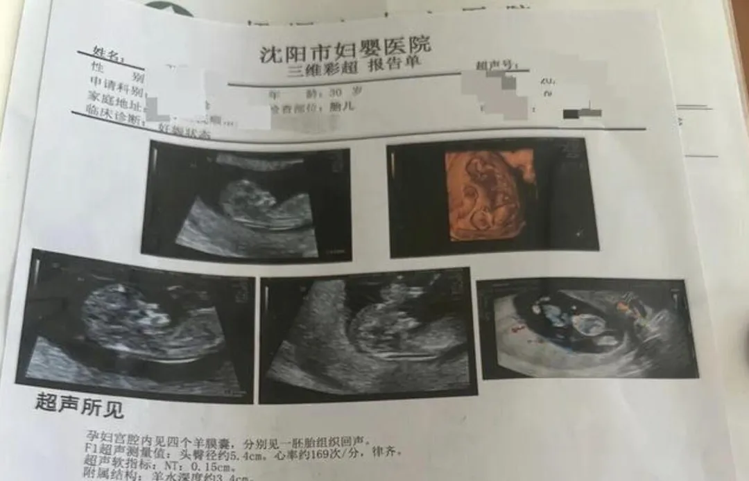 女子目前懷孕已滿16週,同卵四胞胎中有一個是無心畸胎,醫師建議要先阻斷血液供應。(圖/翻攝極目新聞)
