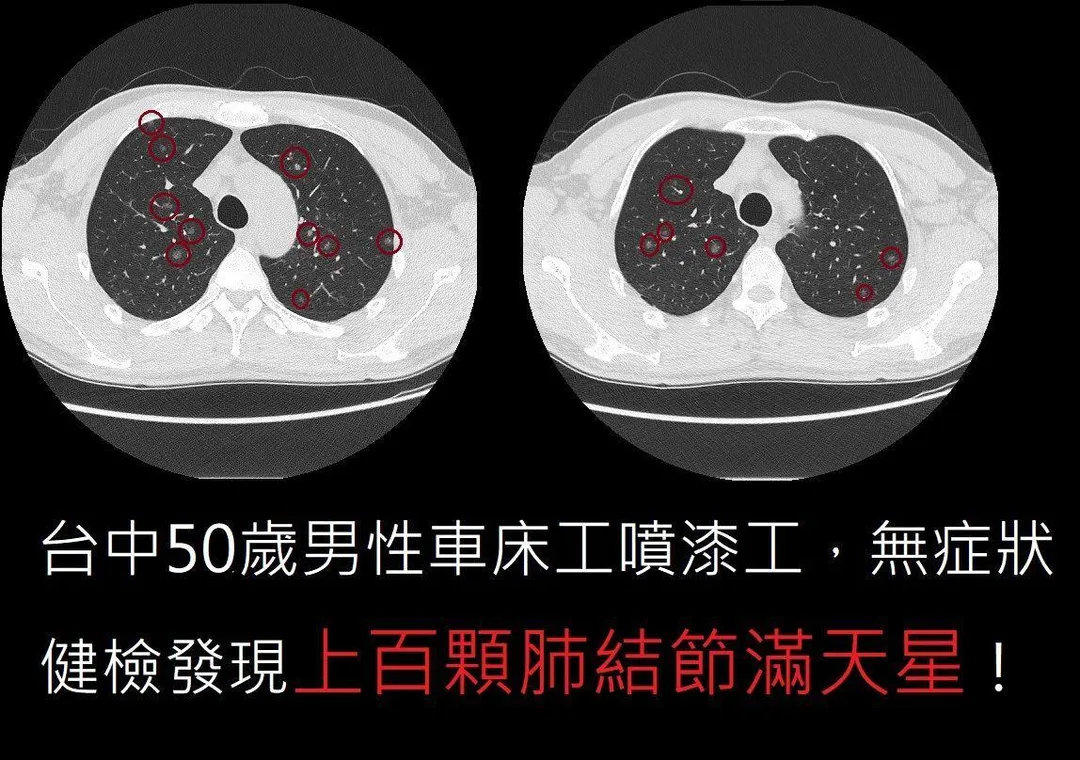 蘇一峰坦言，臨床上面對如此密集的肺結節，根本無法單靠傳統開刀手術全數清除。（圖／翻攝自臉書／蘇一峰）