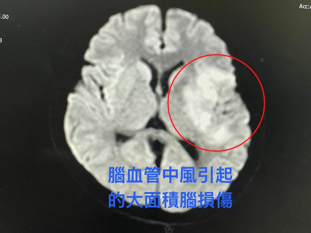 從MRI(核磁共振)影像檢查中明顯看見,因為腦血管中風造成王先生左側腦組織大面積損傷。(圖/花蓮慈濟醫院)