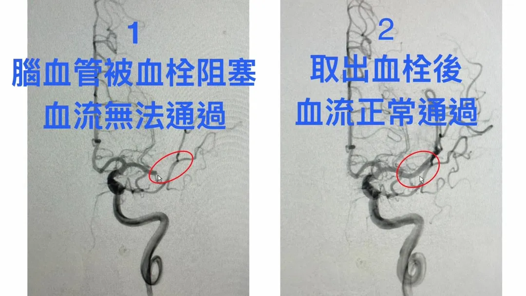 從血管攝影可以清楚看見原本腦血管被血栓阻塞時,血流完全無法通過(左),取栓成功後血流可以正常通過(右)。(圖/花蓮慈濟醫院)