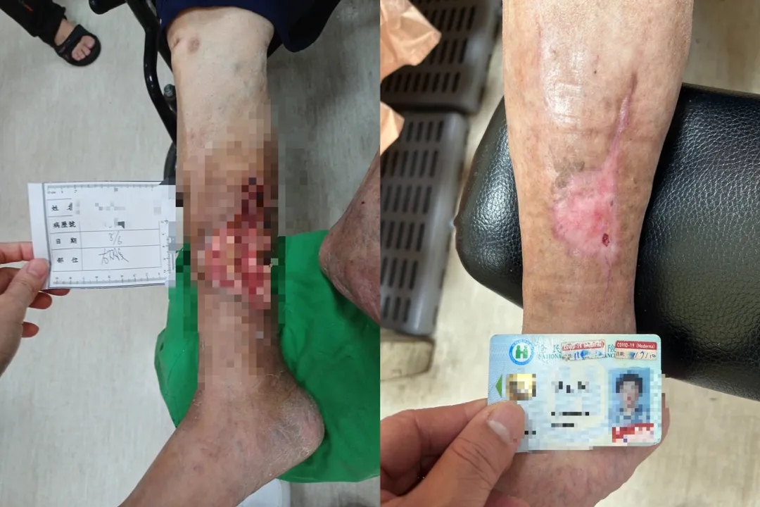 75歲糖尿病患者因車禍右小腿受傷，三週無法癒合，部分組織壞死，經四個多月悉心治療，終於痊癒。（圖／員榮醫院）