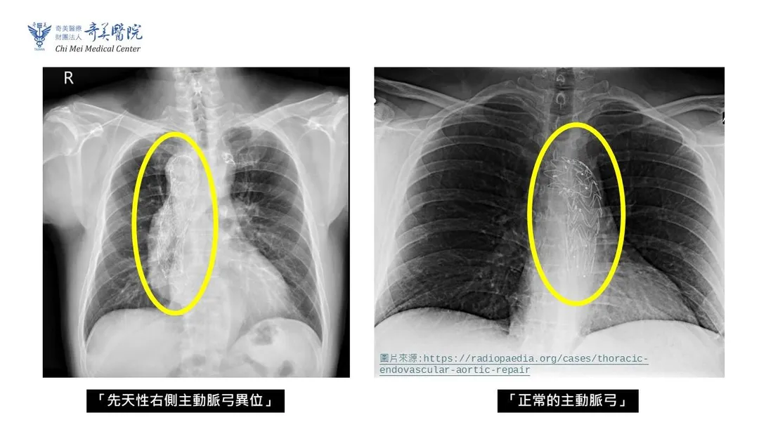 先天性右側主動脈弓異位與正常的主動脈弓比較圖。（圖／奇美醫院）