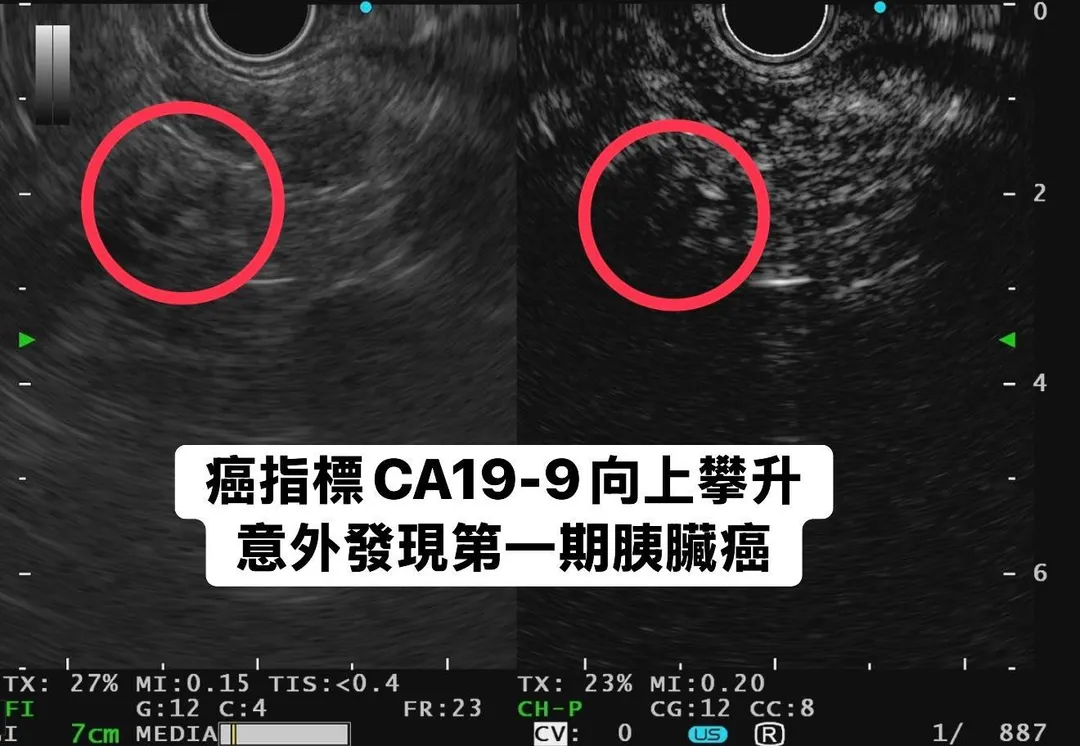 一名70歲女性在例行抽血時發現癌症指標CA19-9數值異常，進一步檢查竟揪出第一期胰臟腺癌。（圖／林相宏臉書「胰臟醫師 林相宏 禾馨民權內科診所」）