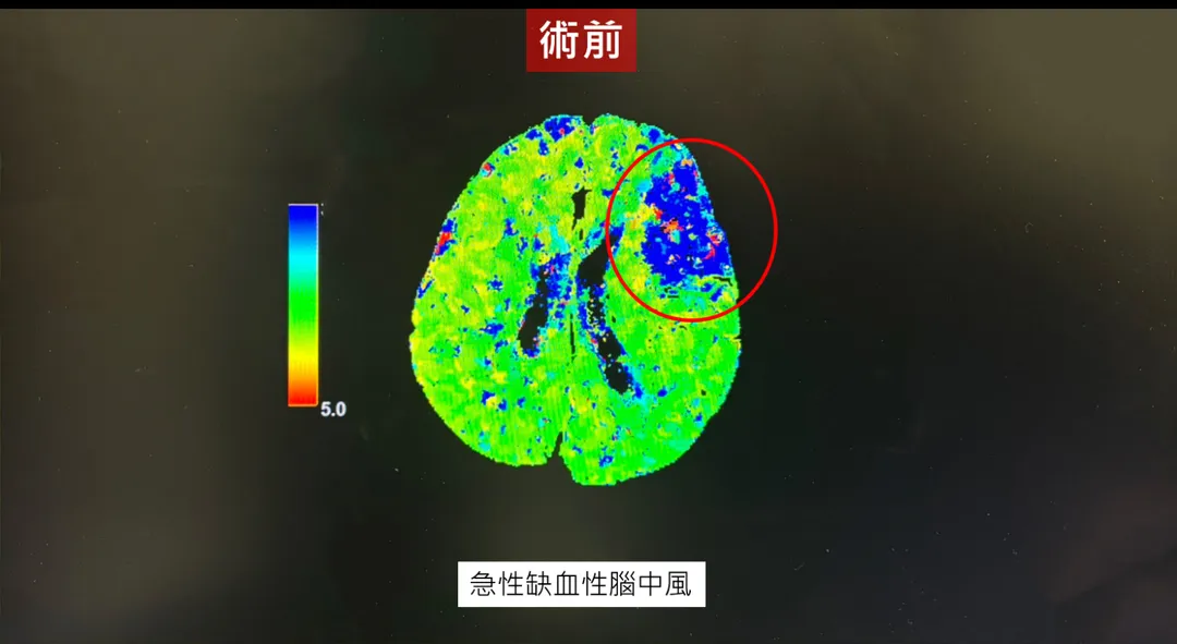 個案影像顯示患者為左側中大腦動脈M2第二分支上支阻塞。（圖／中國醫藥大學新竹附設醫院）