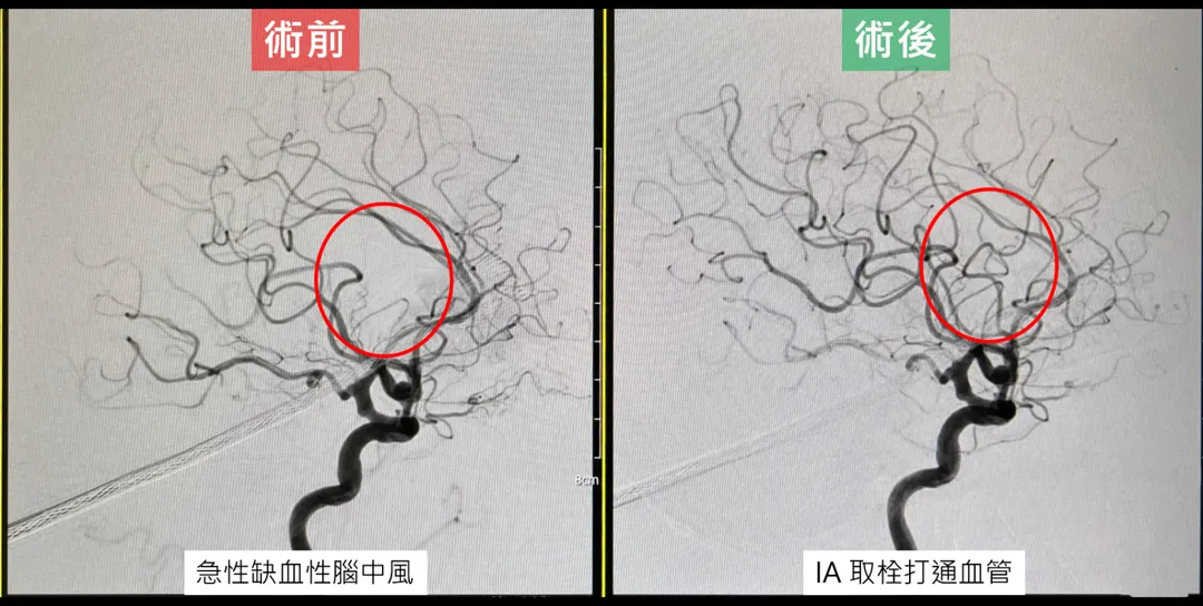 院方透過腦部電腦斷層灌注攝影輔助，確認仍有可搶救腦組織，迅速啟動取栓手術。（圖／中國醫藥大學新竹附設醫院）