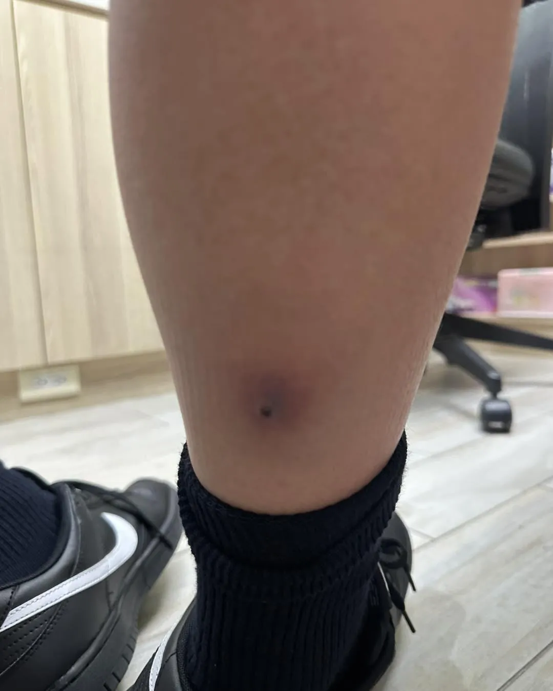 羅士軒隨即拉起男童褲管檢查，發現小腿出現紅腫且有明顯壓痛感。（圖／翻攝臉書「旭恩小兒科診所」）