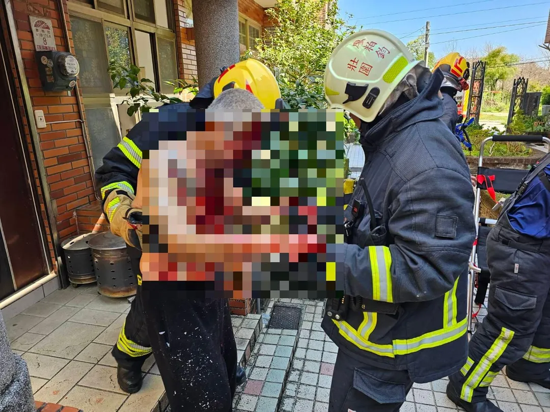 66歲洪男臉部撕裂傷，胸部有一度燒燙傷及撕裂傷。（圖／民眾提供）