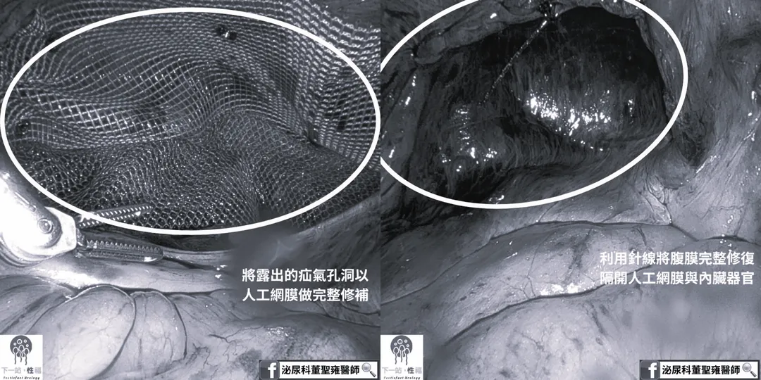 左:將露出的疝氣孔洞以人工網膜做出完整修補。右:利用針線將腹膜完整修復,隔開人工網膜與內臟器官。(圖/安南醫院)