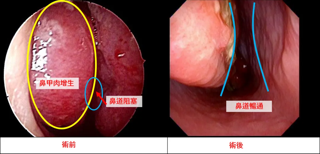 下鼻甲消融併後鼻神經阻斷手術是一種結合「縮小肥厚下鼻甲」與「阻斷過敏神經」的微創鼻內視鏡治療。(圖/中國醫藥大學新竹附設醫院)