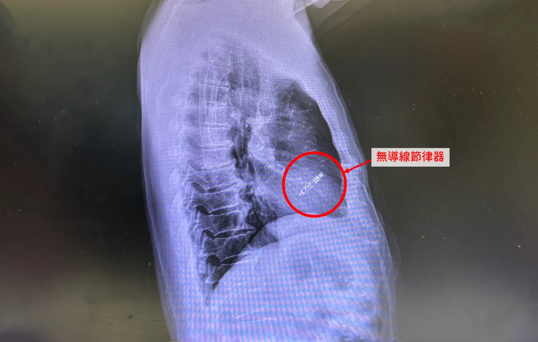 婦人接受心房無導線節律器植入手術,術後心跳恢復至每分鐘60下,各項不適症狀也獲得明顯改善。(圖/中醫大新竹附醫)