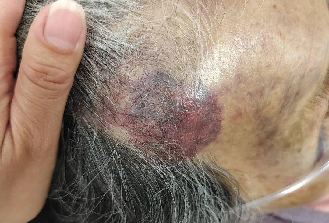 90歲高齡老婦人雙眼、頭部及四肢多處嚴重瘀青挫傷。（圖／中天新聞）