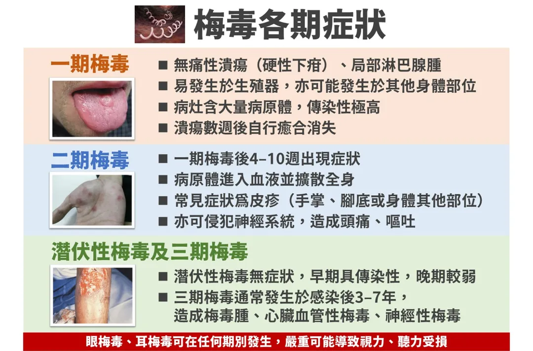 梅毒初期僅出現無痛性潰瘍或皮疹，甚至完全無症狀而延遲就醫。(圖/疾管署)
