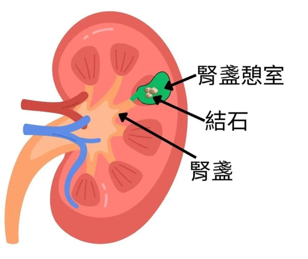 腎盞憩室構造與結石示意圖。（圖／台北慈濟醫院）