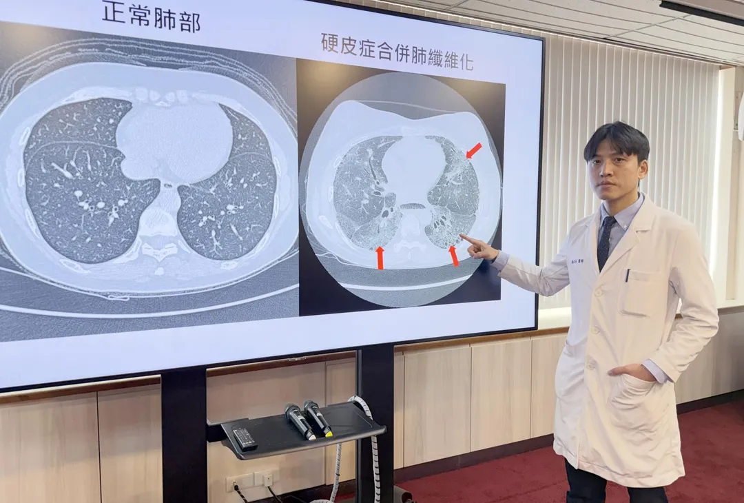 臺中榮總過敏免疫風濕科醫師顏在弘說明，肺纖維化是全身性硬化症嚴重的併發症。中榮研究發現，透過抗體檢測可預測高風險族群。（圖／臺中榮總）