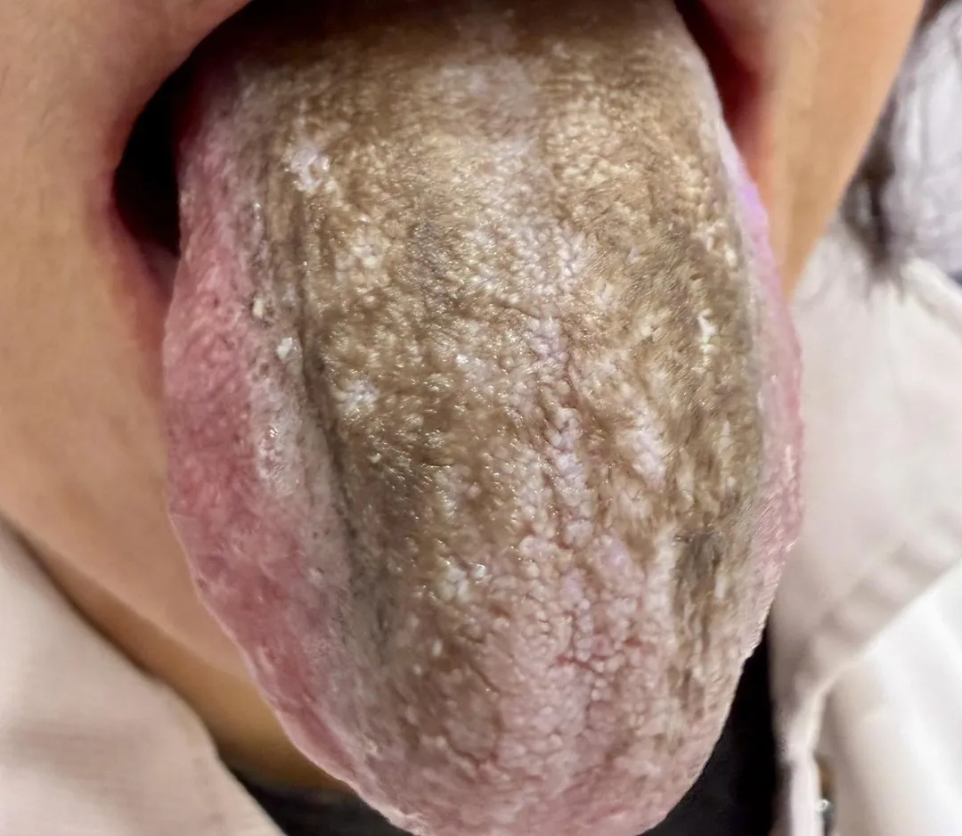 一名嚴重牙周病女患者每次進食後便以強效漱口水沖洗,每日多達五至六次,舌面最終被灰褐色厚苔覆蓋。(圖/臉書「柳雱邁小兒科」)