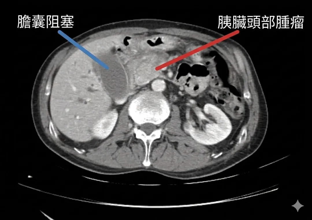 一名60歲女性直到眼白與全身皮膚都明顯泛黃才就醫，進一步確診為胰臟癌。（圖／林相宏臉書「胰臟醫師 林相宏 禾馨民權內科診所」）