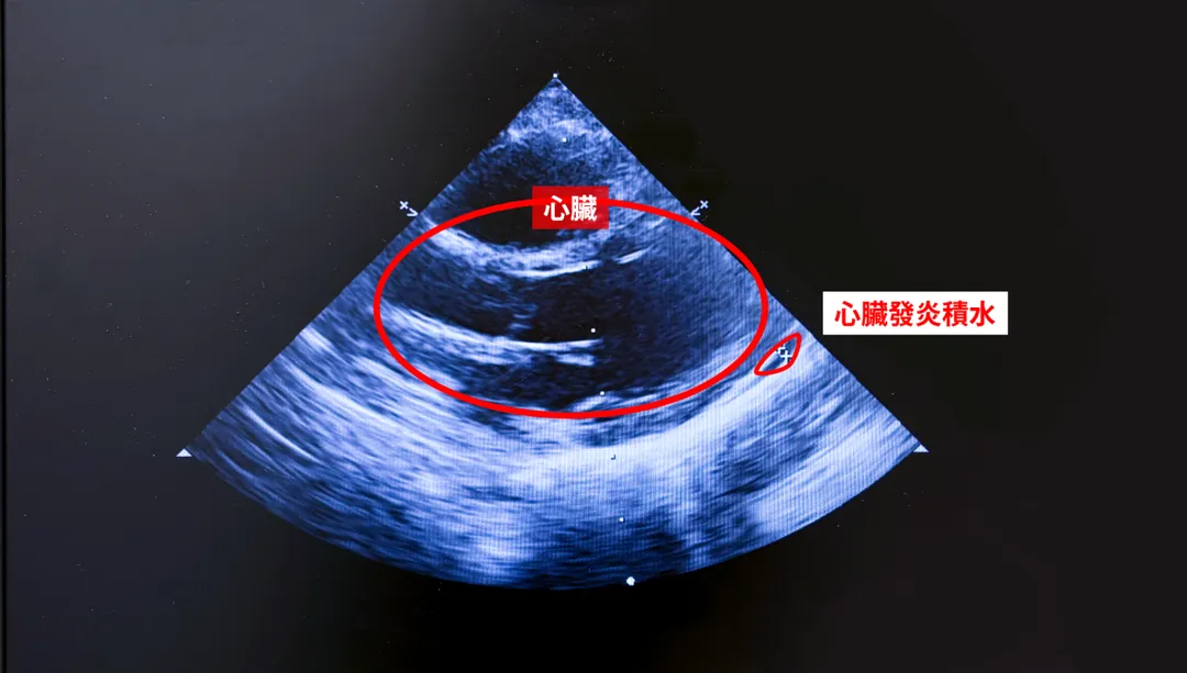 1歲童經抽血追蹤與心臟超音波檢查，診斷為川崎氏症。(圖/中醫大新竹附醫)
