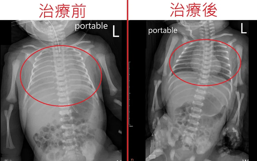 男嬰治療前後X光照。（圖／烏日林新醫院）