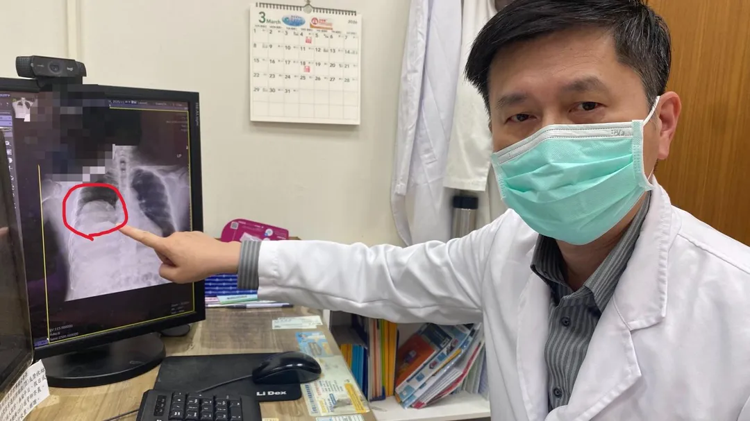 員榮醫院胸腔內科醫師涂川洲副院長，解釋患者因25公分的肺部腫瘤（圖中紅圈處）導致多次低血糖昏倒。（圖／員榮醫院）