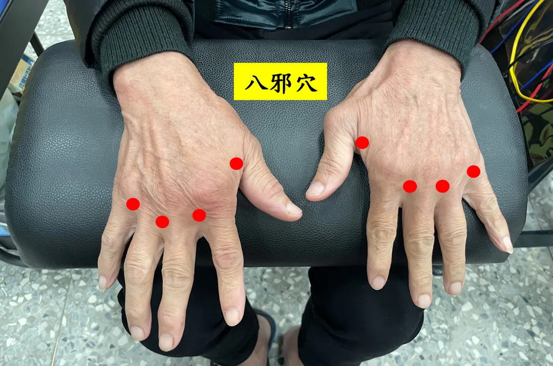 治療上選用「八邪穴」作為主要穴位，位於手背第一至第五指間指縫後方凹陷處。（圖／台南市立醫院）