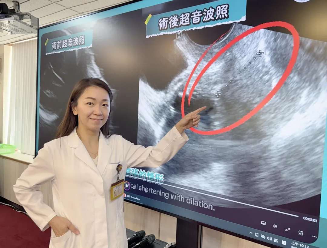 臺中榮總婦女醫學部醫師林俐伶指出，經過第2次環紮，以超音波檢查可見子宮頸閉鎖不全處已經順利閉合(紅圈處)。（圖／臺中榮總）