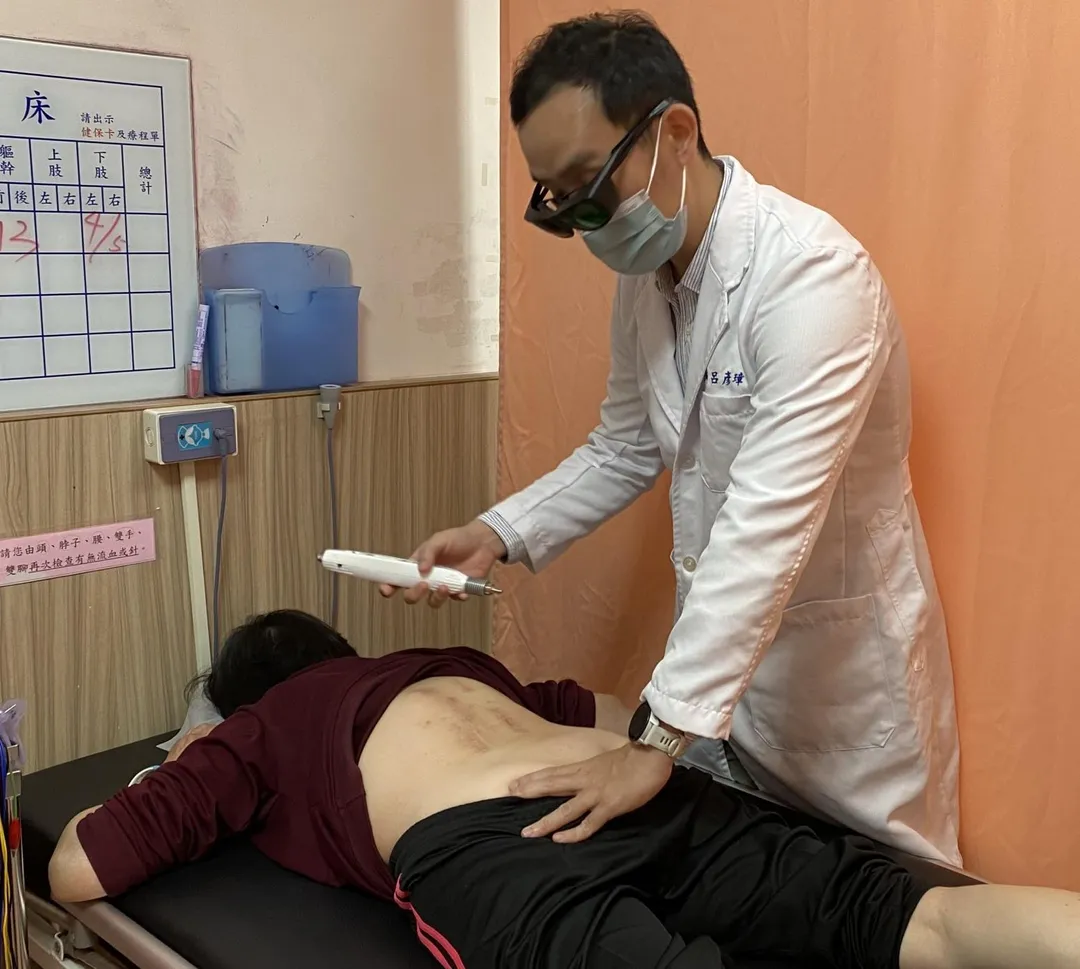 員榮醫療體系員榮醫院中醫部呂彥璋醫師,為背痛難耐的患者,進行雷射針炙,可以清晰看見患者背部因開刀留下的疤痕。(圖/員榮醫院)