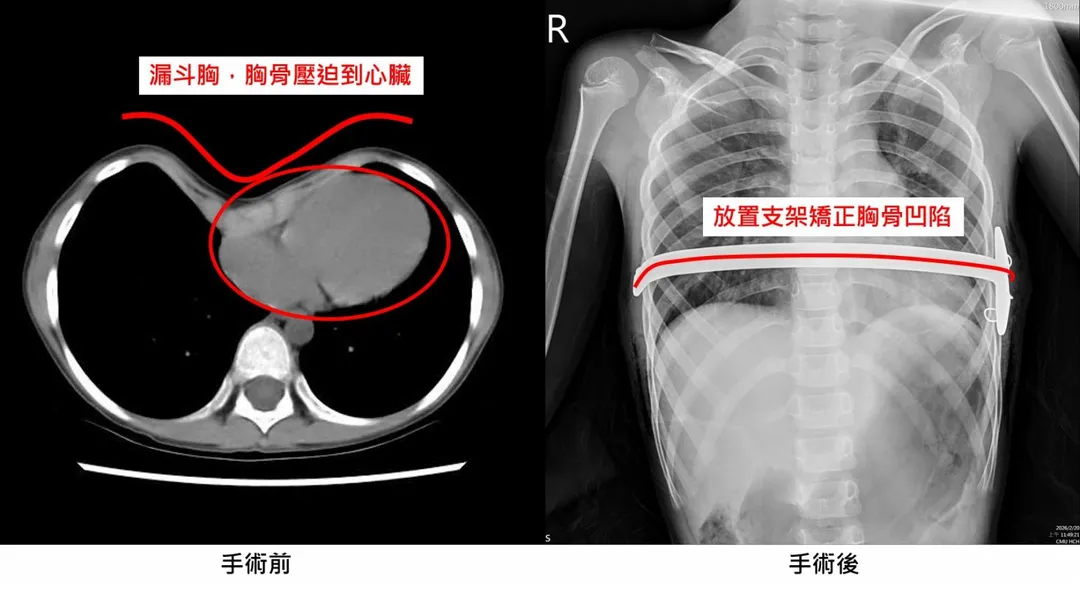 一名約9歲男童胸部明顯凹陷，經電腦斷層確診為「大峽谷型」漏斗胸，執行微創手術後3天順利出院。（圖／中國醫藥大學新竹附設醫院）