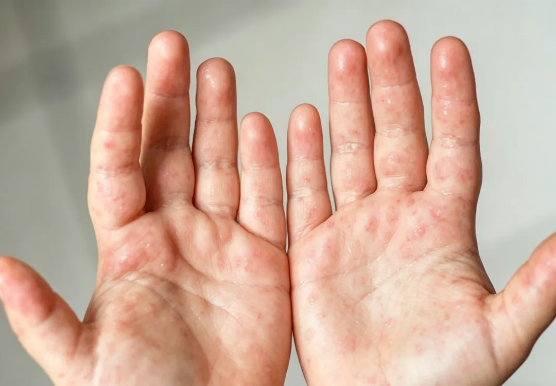 成年人感染腸病毒後，症狀可能不明顯，容易被誤認為感冒或疲勞，但仍可能將病毒帶回家傳染給孩子。（示意圖／AI生成圖）