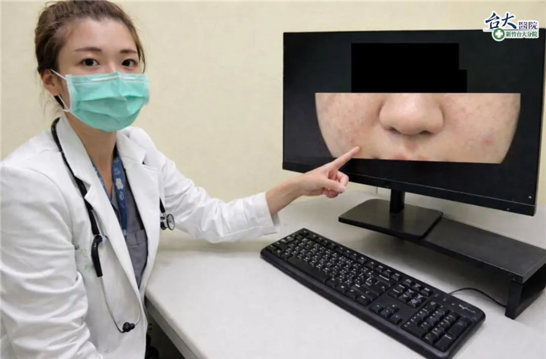新竹臺大分院兒科急診醫師石庭慧說明,臉部、嘴唇或眼皮腫脹可能是過敏性休克前兆之一。(圖/新竹臺大分院提供)