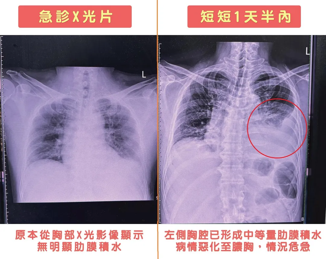 患者因突發性左側劇烈胸痛就醫，短短36小時內病情急速惡化，確診感染罕見「微小微單胞菌」並演變為膿胸。（圖／烏日林新醫院）