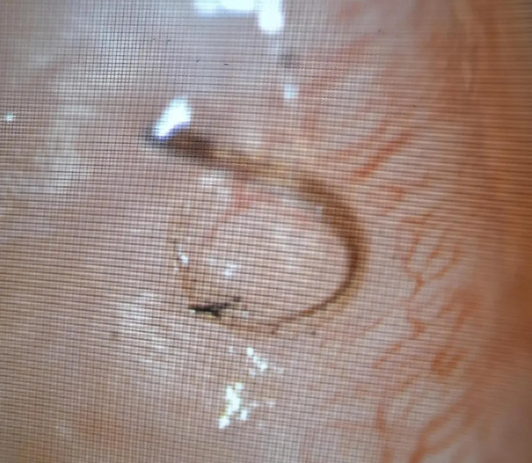 猛拉魚鉤，效果都不佳。醫師靈機一動下，反方向用力將魚鉤向前移動幾公分之後，順勢轉個方向，輕鬆的從之前刺入的結膜傷口取出。（圖／洪啟庭醫師提供）