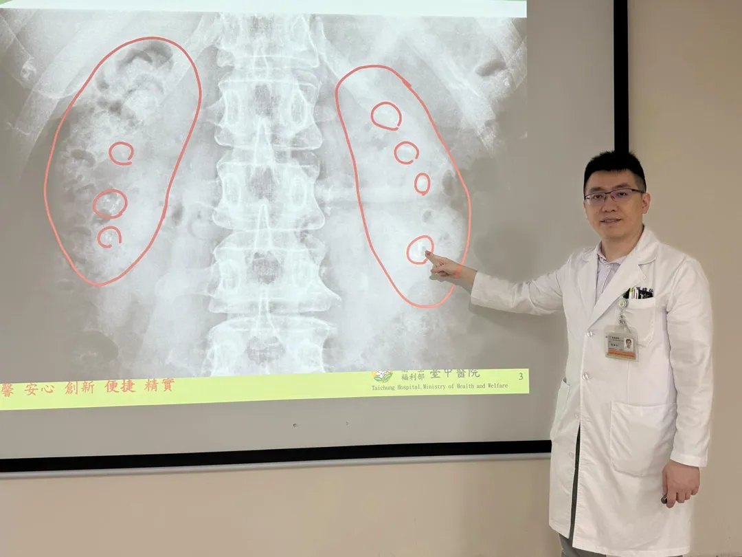 衛生福利部臺中醫院泌尿科簡維弘醫師說明，患者X光片顯示雙側腎臟內都有明顯的「雷射斑」，宛如兩顆鑲滿葡萄乾的雜糧麵包。（圖／臺中醫院）