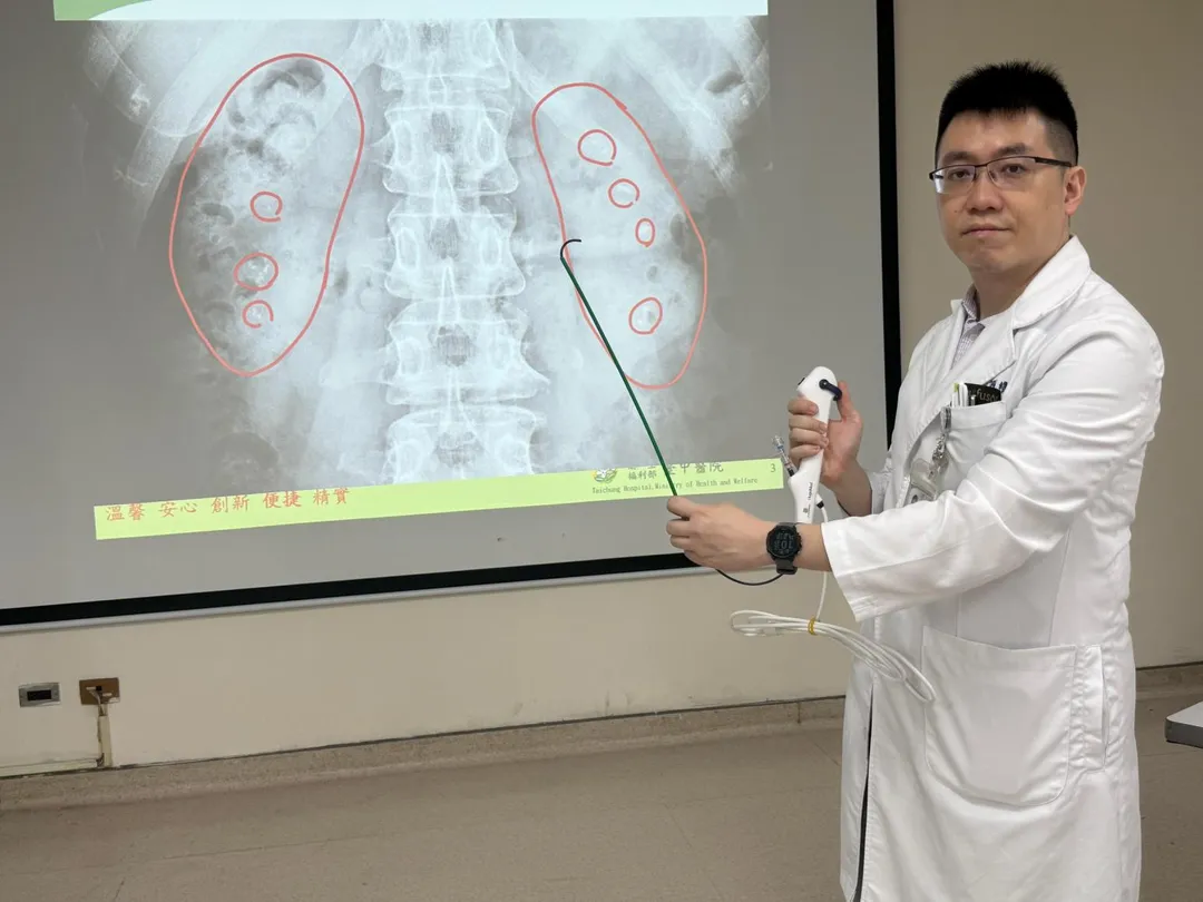簡維弘醫師示範利用軟式輸尿管鏡從尿道進入腎臟，以雷射碎石後取出體外的手術方式。（圖／臺中醫院）