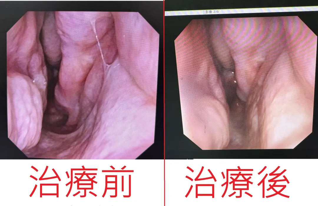治療後重新縮小鼻腔體積,引導氣流回歸正常路徑,是目前較具成效的根治方案。(圖/烏日林新醫院)