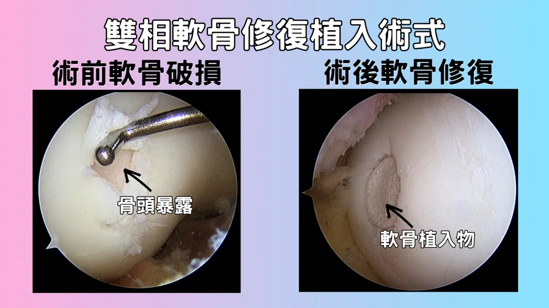 五年長期追蹤研究顯示,再生軟骨厚度明顯增加,質地高度接近天然透明軟骨,展現出優於傳統手術的長效穩定性。(圖/中國醫藥大學新竹附設醫院)