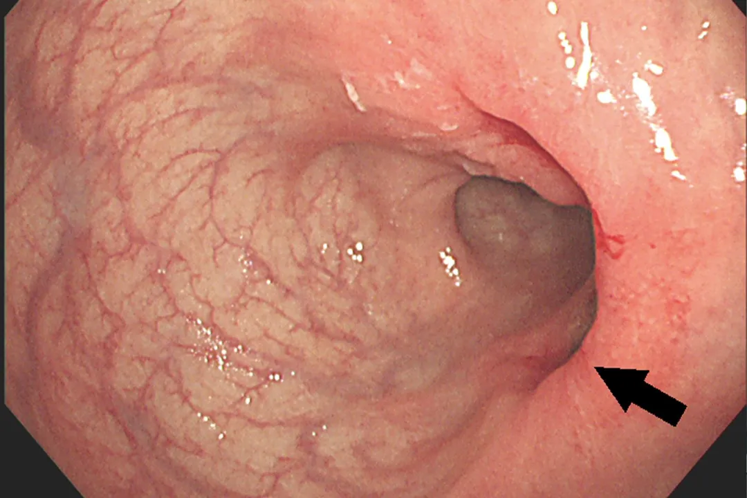 患者接受前導性放化療後，大腸鏡複查之腸道影像。（圖／彰化基督教醫院）