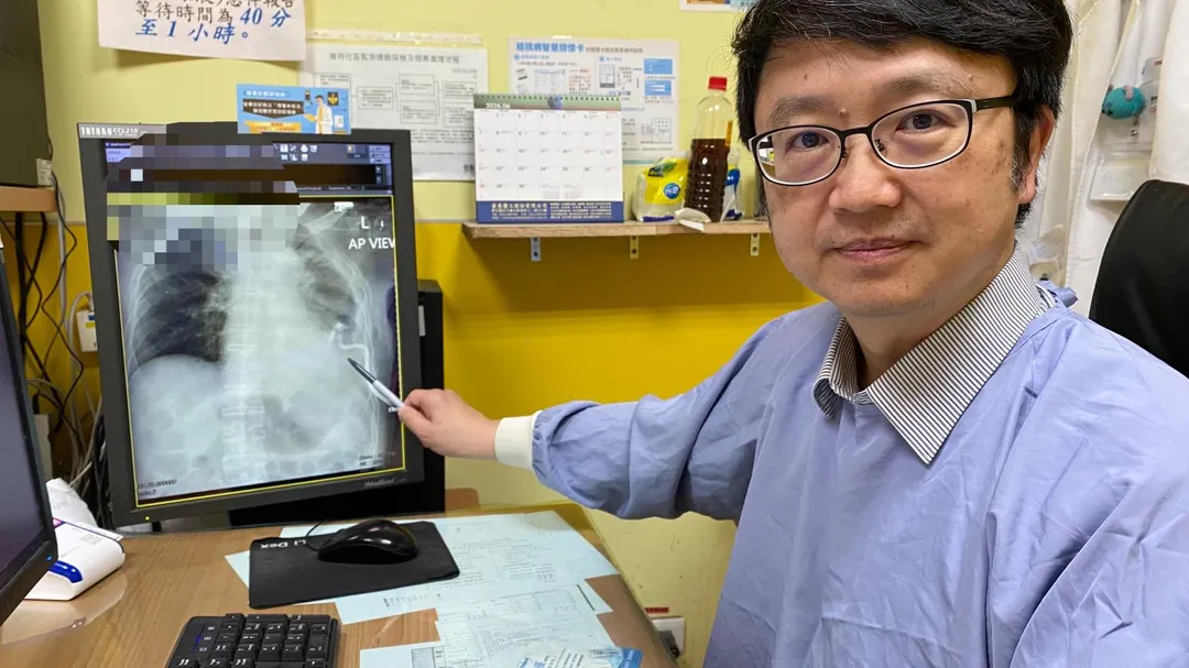 員榮醫院胸腔科主任林鴻慶醫師手指處即為俗稱「豬尾巴」的引流管。（圖／員榮醫院）